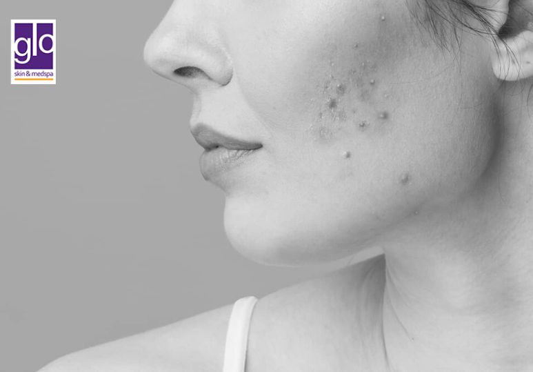 Microneedling And Acne: What You Need To Know